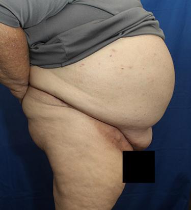 After Results for Panniculectomy
