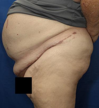 After Results for Panniculectomy