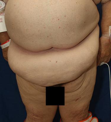 Before Results for Panniculectomy