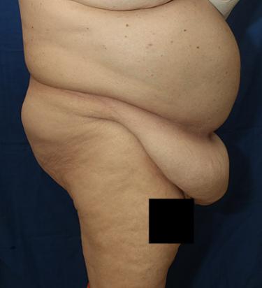 Before Results for Panniculectomy