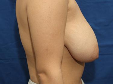 Before Results for Breast Reduction