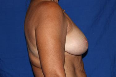 Before Results for Breast Lift