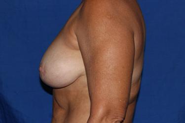 Before Results for Breast Lift