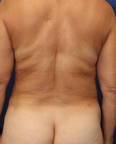 After Results for Liposuction