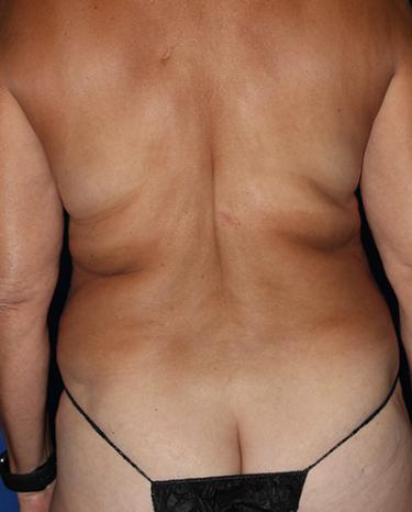 Before Results for Liposuction