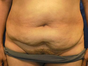 Before Results for Tummy Tuck