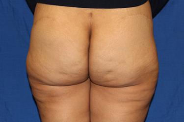 After Results for Brazilian Butt Lift / Gluteal Augmentation