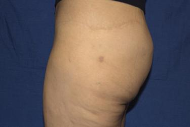 After Results for Gluteal Augmentation