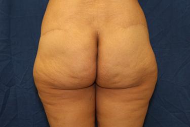 Before Results for Gluteal Augmentation