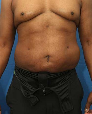After Results for Liposuction