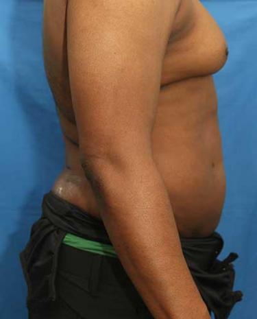 After Results for Liposuction