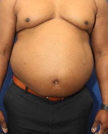 Before Results for Liposuction