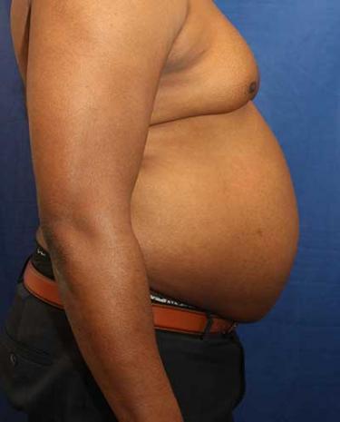 Before Results for Liposuction