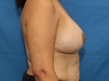 After Results for Breast Augmentation