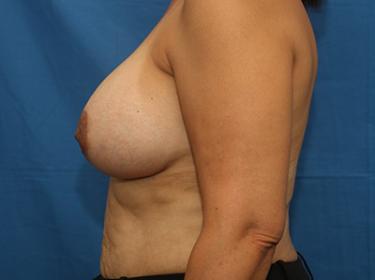 After Results for Breast Augmentation
