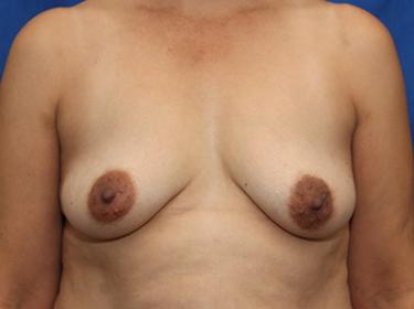 Before Results for Breast Augmentation
