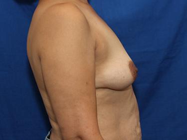 Before Results for Breast Augmentation