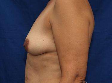 Before Results for Breast Augmentation