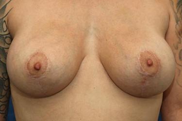 After Results for Breast Lift / Mastopexy