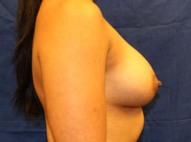 After Results for Breast Augmentation