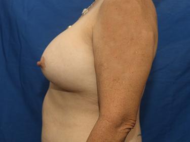 After Results for Breast Augmentation