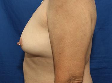 Before Results for Breast Augmentation