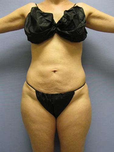 After Results for Liposuction