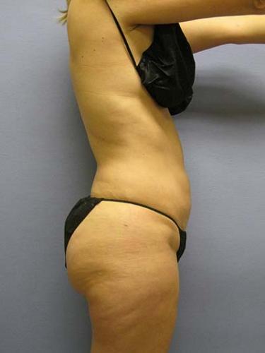 After Results for Liposuction