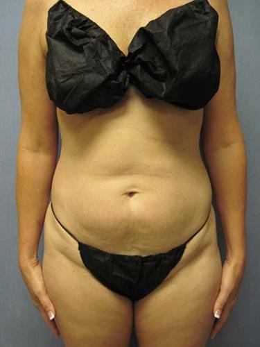 Before Results for Liposuction