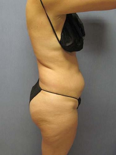Before Results for Liposuction