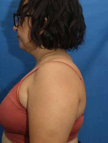 After Results for Liposuction