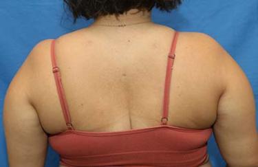 After Results for Liposuction