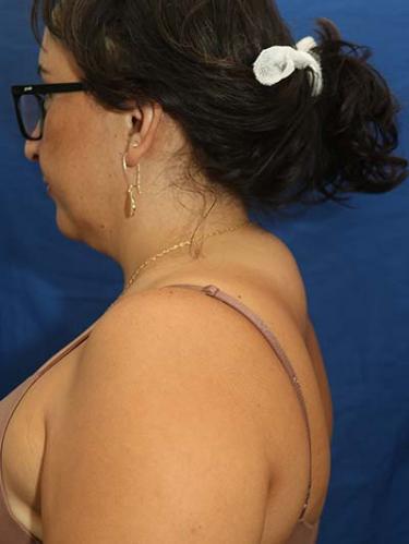 Before Results for Liposuction