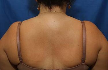 Before Results for Liposuction