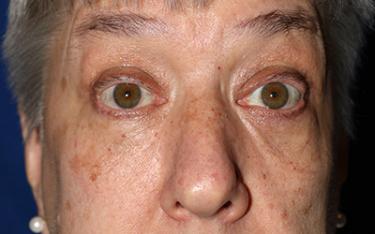 After Results for Blepharoplasty