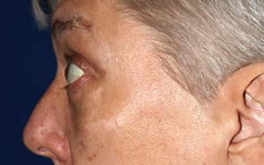 After Results for Blepharoplasty