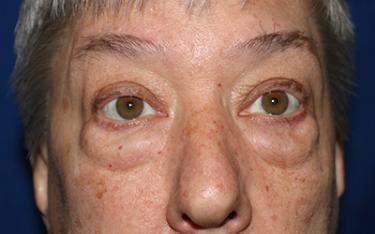 Before Results for Blepharoplasty