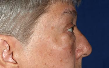 Before Results for Blepharoplasty