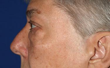 Before Results for Blepharoplasty