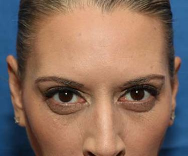 After Results for Neuromodulators (Botox / Dysport)