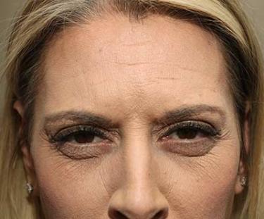 Before Results for Botox