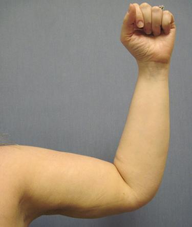 After Results for Liposuction