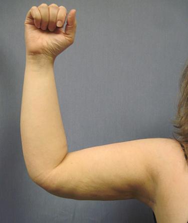 After Results for Liposuction