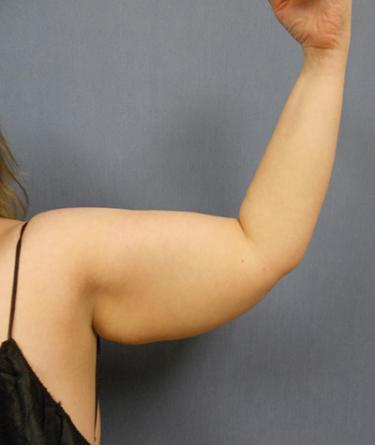 Before Results for Liposuction