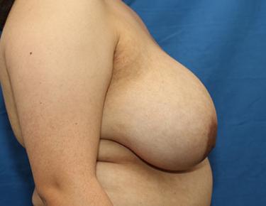 Before Results for Breast Reduction