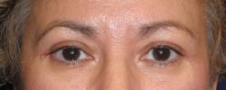 After Results for Blepharoplasty