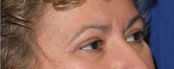 After Results for Blepharoplasty