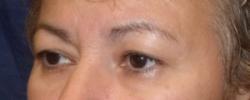 Before Results for Blepharoplasty