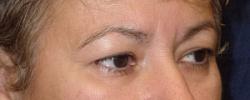 Before Results for Blepharoplasty