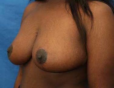 After Results for Breast Reduction